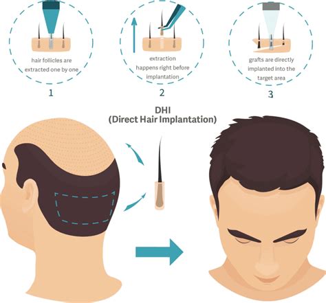 Haartransplantatie DHI: Stapsgewijze Uitleg