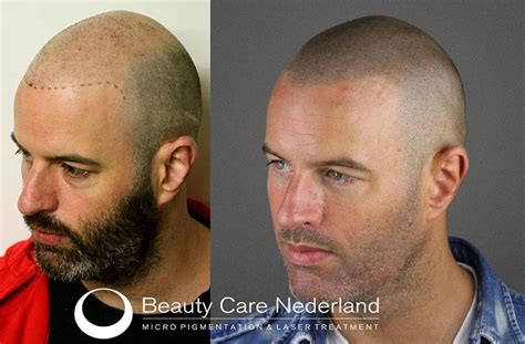 Haartransplantatie Voor Scalp-Pigmentatie