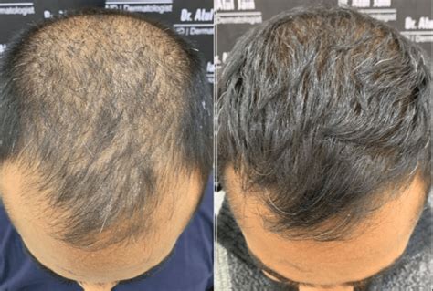 PRP En Haartransplantatie: Kun Je Ze Combineren?