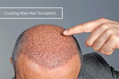 Haartransplantatie En Leeftijd: Wanneer Is Het Ideaal?