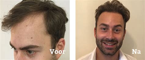 Haartransplantatie Kosten Voor Mannen Vs. Vrouwen