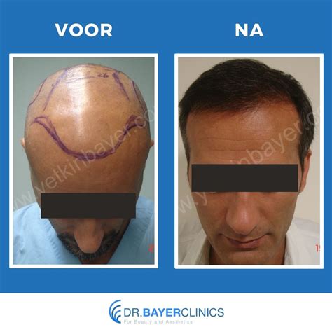 Haartransplantatie: Voor En Na Foto'S