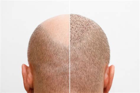 Haartransplantatie Trends Voor 2023