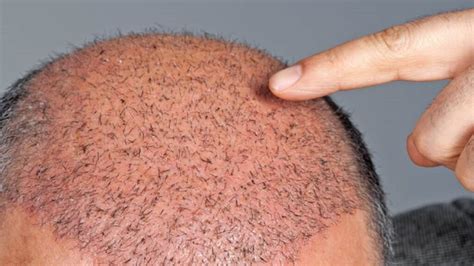 Is Haartransplantatie Veilig?